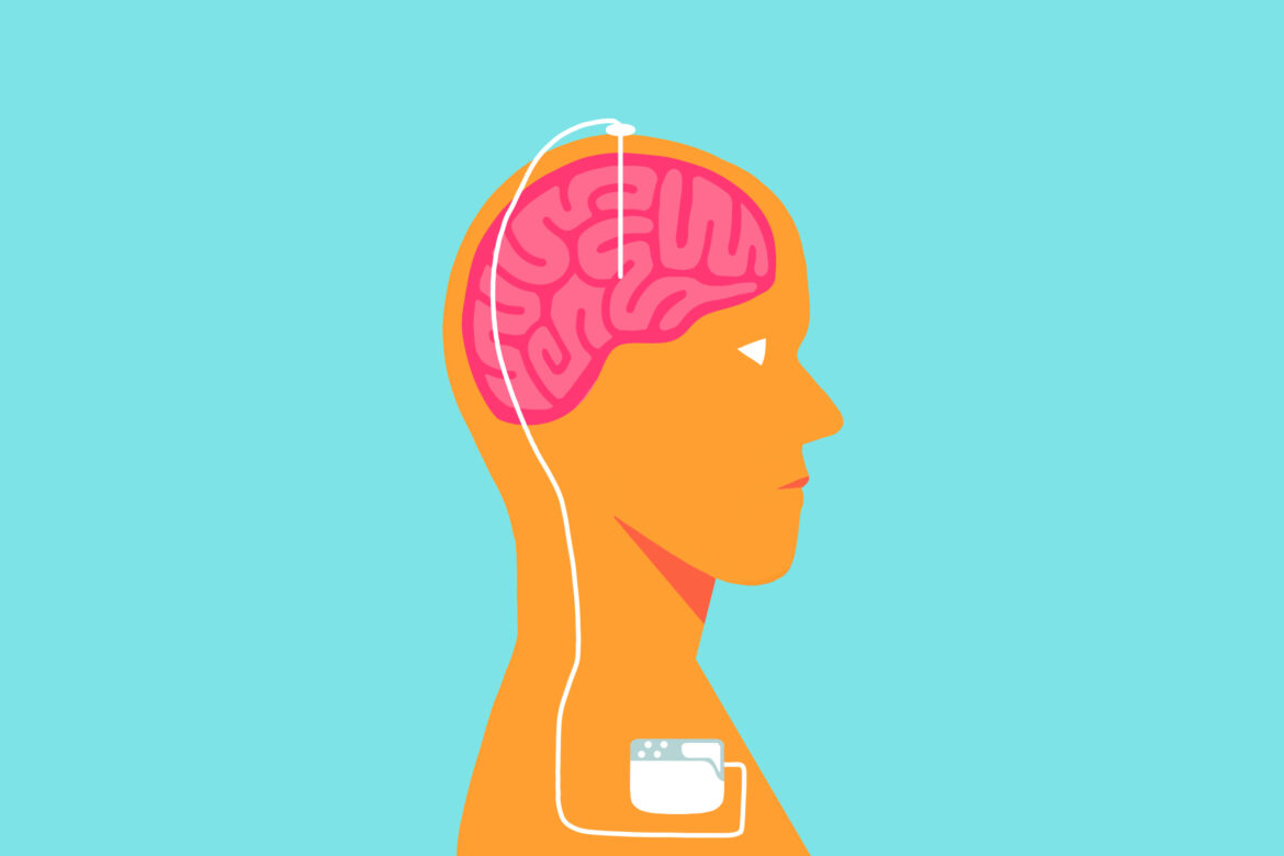 Rewiring the mind: Neurologists discuss deep brain stimulation with a stroke survivor